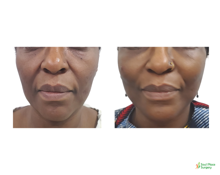 Facelift before and after result 1 — Soul Place Surgery, Abuja