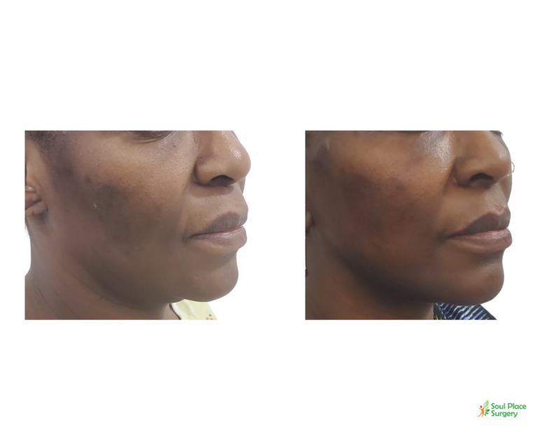 Facelift before and after result 3 — Soul Place Surgery, Abuja